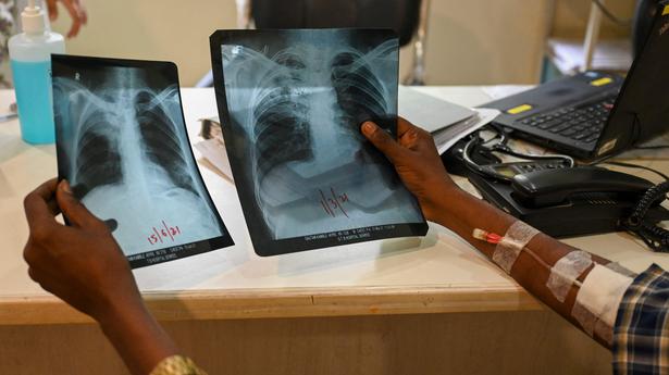Data | How did COVID affect TB treatment in India?