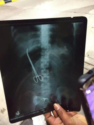 Image result for forceps inside woman stomach