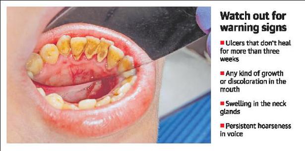 Be On Your Guard There S Cancer Lurking In Your Mouth The Hindu