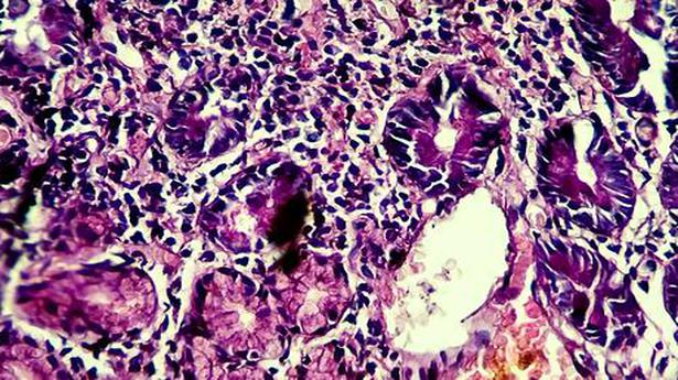 AI tool to simplify identification of cancerous tissue in tumours