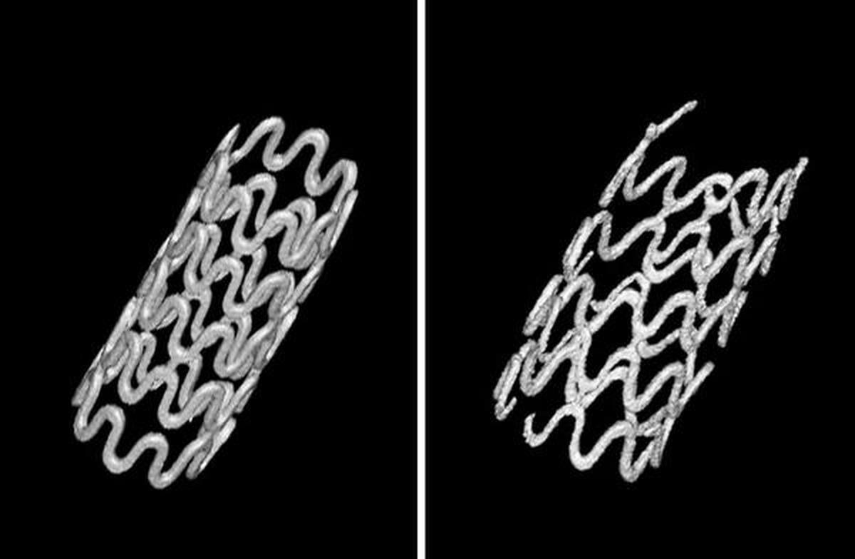 Researchers demonstrate for the first time the successful use of a completely biodegradable magnesium-alloy tracheal stent, pictured, that safely degrades and does not require removal. (Credit: Materialise)
